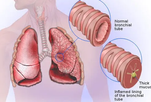 bronchitis_s2_diagram.jpg